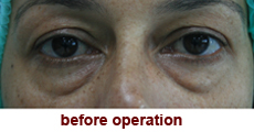 plastic-surgery-blepharoplasty